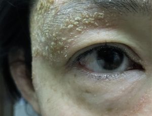 瞼の湿疹