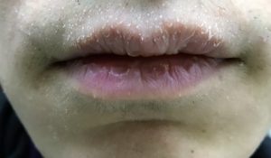 唇の湿疹
