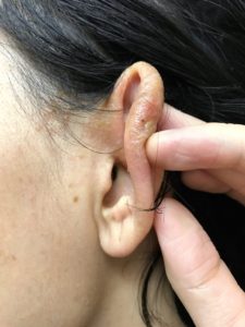 耳の湿疹