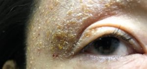瞼の湿疹