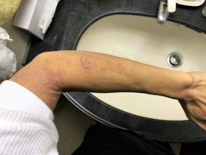 腕の湿疹