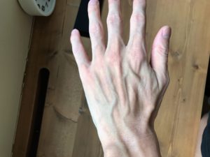手の湿疹