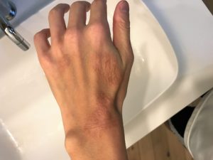 手の湿疹