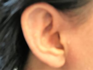 耳の湿疹