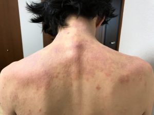 背中の湿疹
